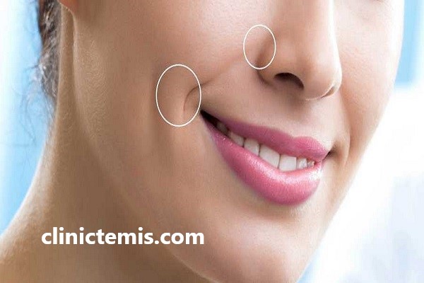 بررسی مدت زمان ماندگاری ژل خط خنده | کلینیک تمیس