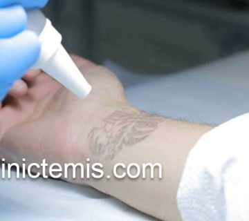 پاک کردن تاتوهای بدن در جنوب تهران | کلینیک تمیس