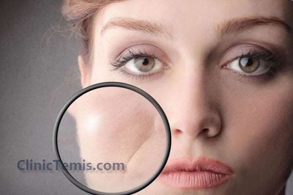 اقدامات ضروری برای امادگی قبل از تزریق ژل خط خنده