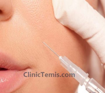 مدت زمان ماندگاری ژل خط خنده چقدر است؟ | کلینیک تمیس