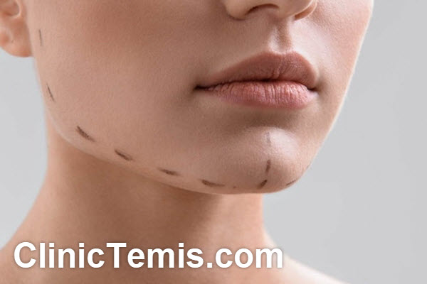 تزریق ژل چانه | کلینیک تمیس