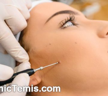 بهترین کلینیک برداشتن خال و زگیل در نازی آباد | کلینیک تمیس