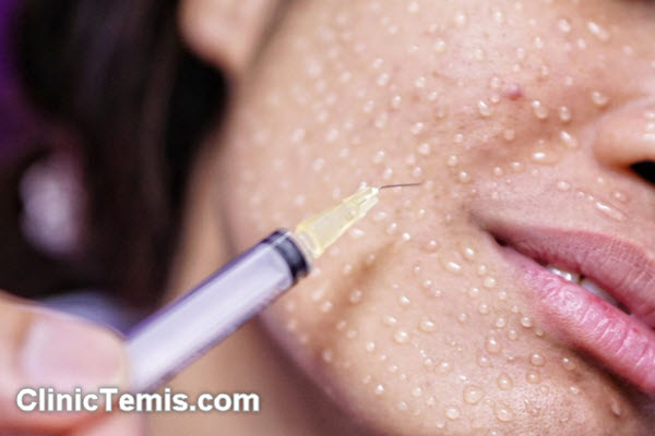 مقایسه مزوتراپی صورت با دیگر روش های درمانی | کلینیک تمیس