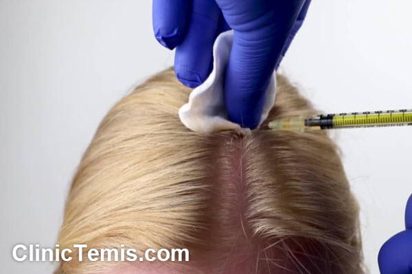 ویژگی های بهترین کلینیک مزوتراپی مو در جنوب تهران | کلینیک تمیس