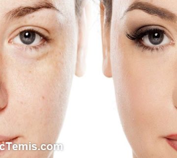 تاثیر میکرونیدلینگ بعد از چند روز است؟ | کلینیک تمیس