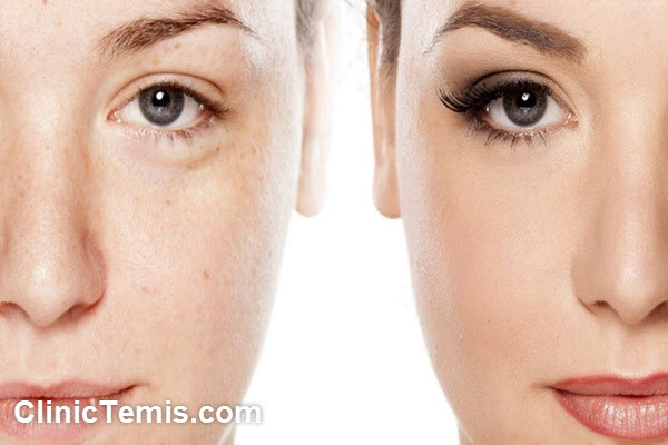 تاثیر میکرونیدلینگ بعد از چند روز است؟ | کلینیک تمیس