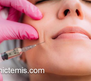 رفع خط خنده با تزریق ژل | کلینیک تمیس