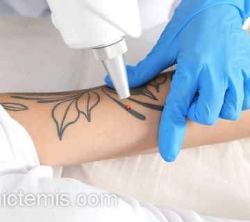 حذف تاتو با لیزر کیوسوئیچ | کلینیک تمیس