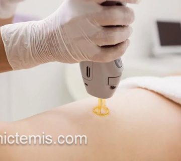 لیزر موهای زائد در کلینیک معتبر | کلینیک تمیس