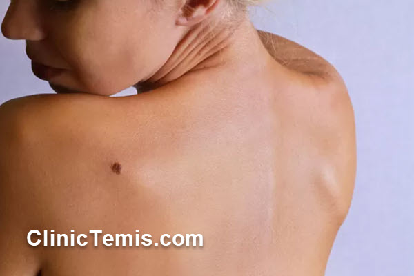 خال گوشتی چیست و چرا باید برداشته شود؟