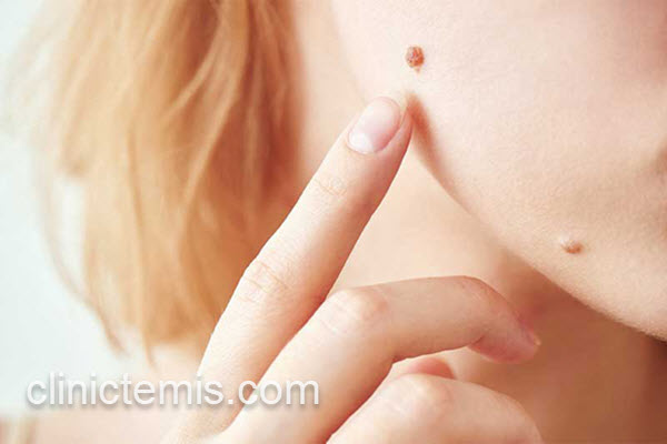 پزشک خوب برای برداشتن خال های گوشتی | کلینیک تمیس