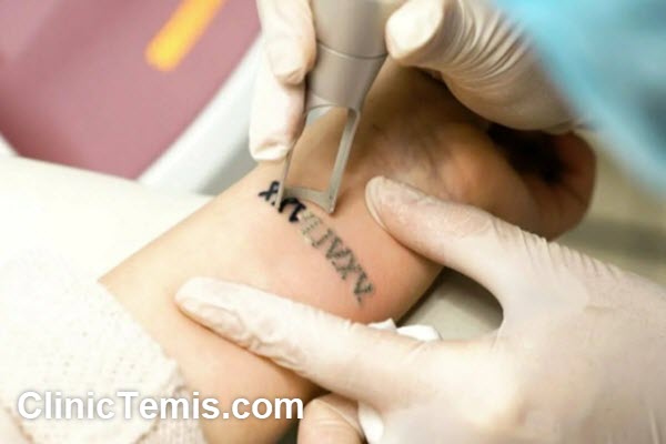 هزینه پاک کردن تاتو ابرو در کلینیک تمیس