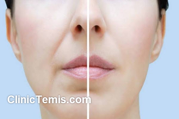 نتیجه طبیعی با تزریق اصولی